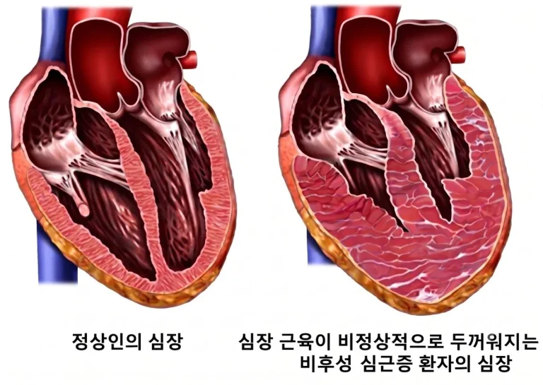 비후성 심근증 저·중간 위험군, LARS 21% 미만이면 위험 약 6배