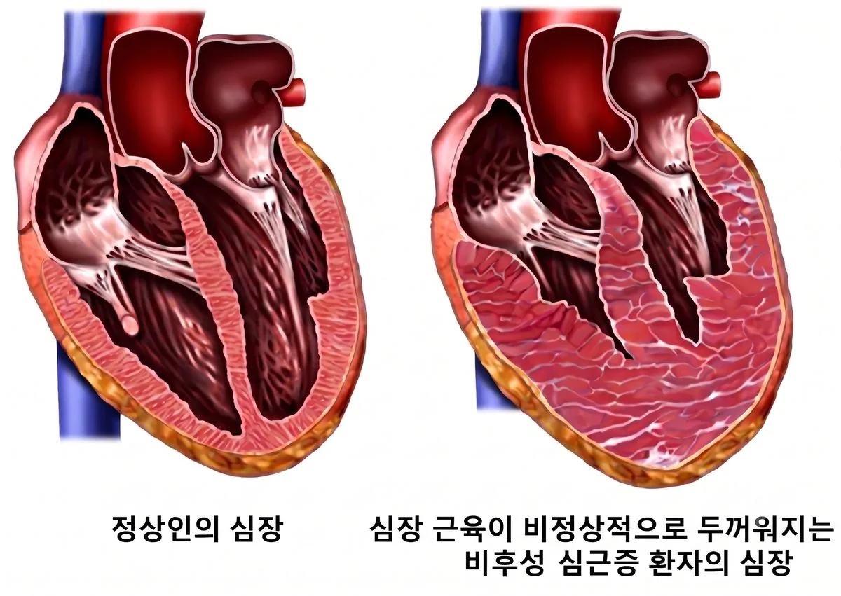 비후성 심근증 저·중간 위험군, LARS 21% 미만이면 위험 약 6배