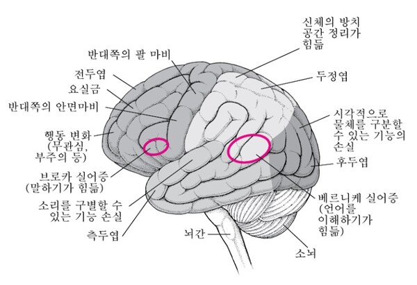 뇌의 특정 영역들이 손상된 경우 / MSD 매뉴얼