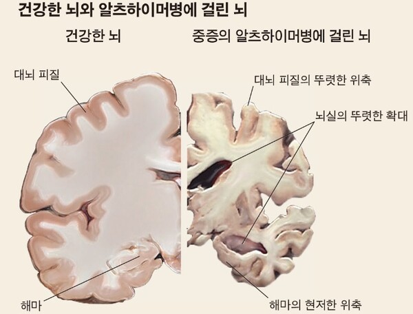 알츠하이머, 수혈 시 전염 가능성 제기