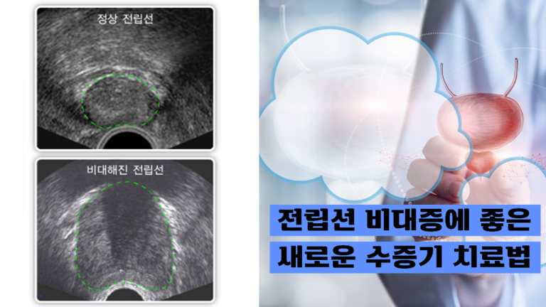 리줌시술, 전립섭비대증 새로운 치료법등