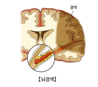 출처 : 서울아산병원 질병정보