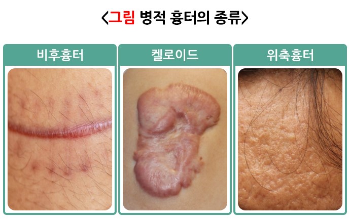 '병적 흉터'에 해당하는 켈로이드 / 출처 : 국가건강정보포털