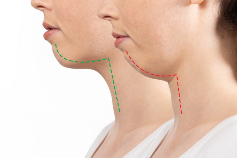 양악수술 = 성형수술? 턱교정수술에 대해 알아두어야 할 것들