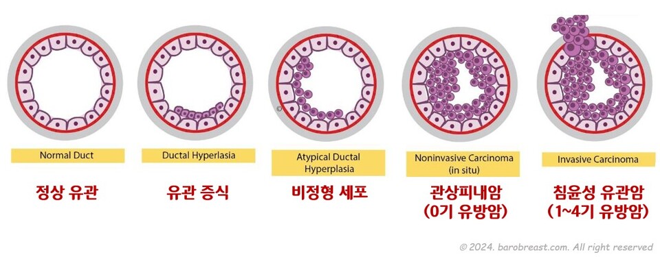 유방암의 발생 과정 / 출처 : DOI: 10.20473/jmv.vol6.iss2.2023.271-287 (논문) / 제공 : 서울보라매병원