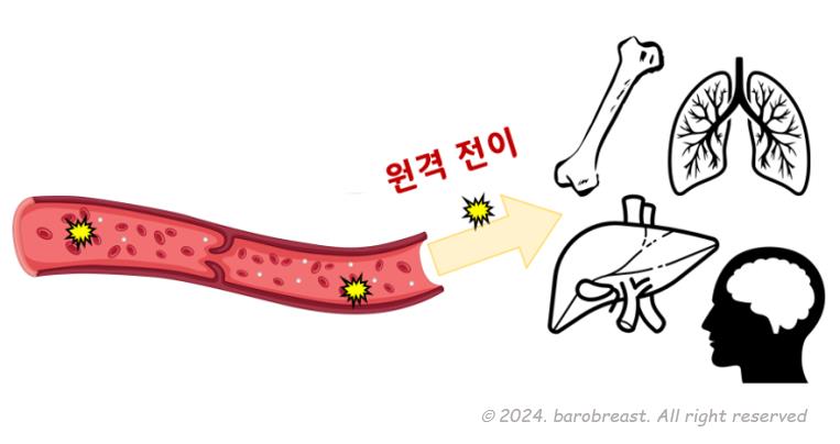 유방암의 타 장기로의 원격 전이 / 제공 : 서울보라매병원