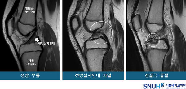 [그림] 정상 무릎 및 무릎 부상 환자의 MRI_250806