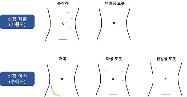 서울대병원, 단일공 로봇 생체 신장이식 아시아 최초 성공